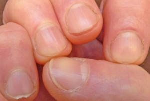 как выглядят обгрызанные ногти